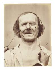 GUILLAUME-BENJAMIN DUCHENNE DE BOULOGNE (1806–1875) GUILLAUME-BENJAMIN DUCHENNE DE BOULOGNE (1806–1875)