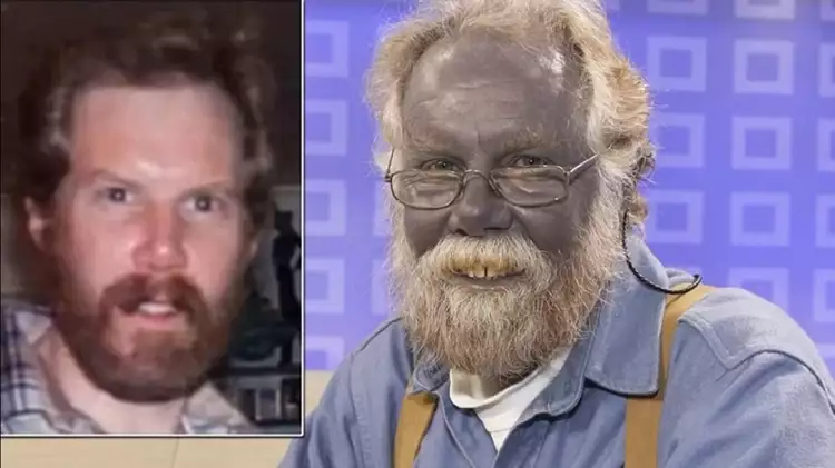 L'argent. Paul Karason est un homme qui souffre d'argyrose (peau bleue)